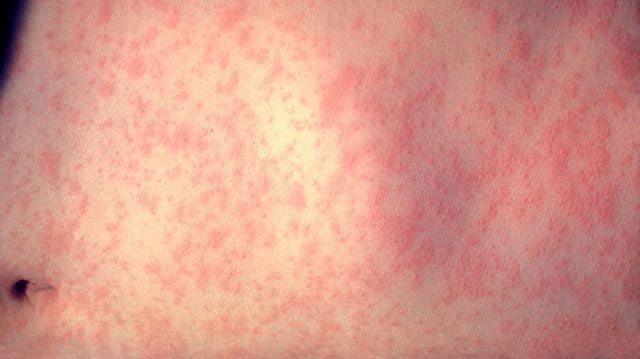 Skin of a person after three days of measles infection. Photo CDC/Dr Heinz F Eichenwald