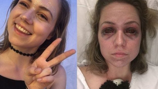 Lorne Falls Festival stampede victim 'Maddy' said she still doesn't have white in her eyes 'it's just blood' after she was trampled on. Photo: Triple J Hack 